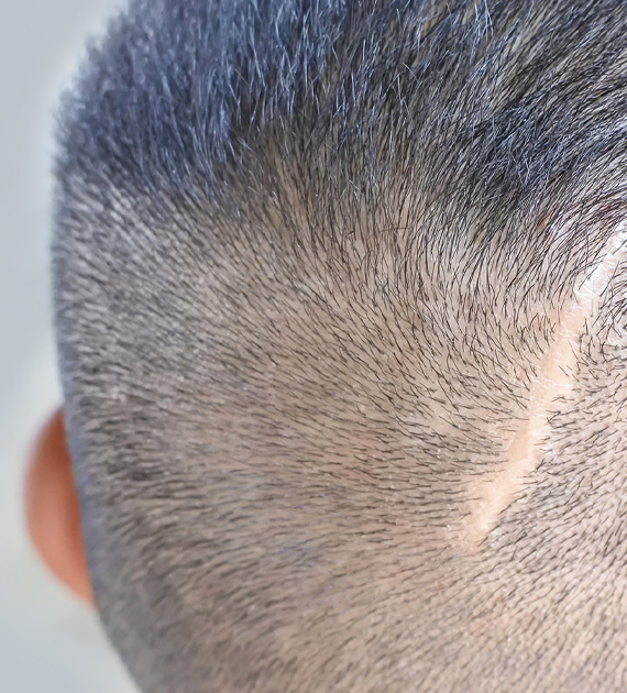 Gynecomastia Consultation Image